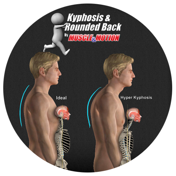 Kyphosis & rounded back