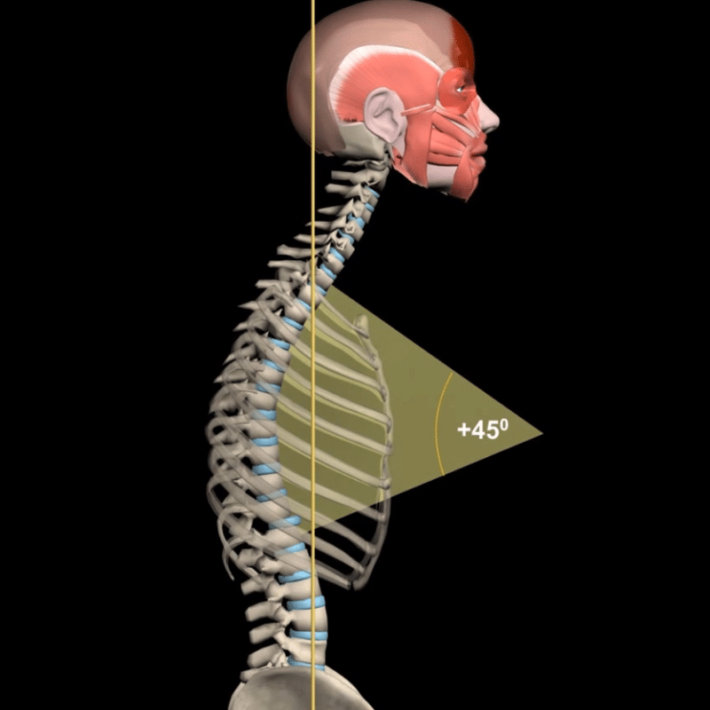 תמונה ראשית לעמוד בלוג Kyphosis