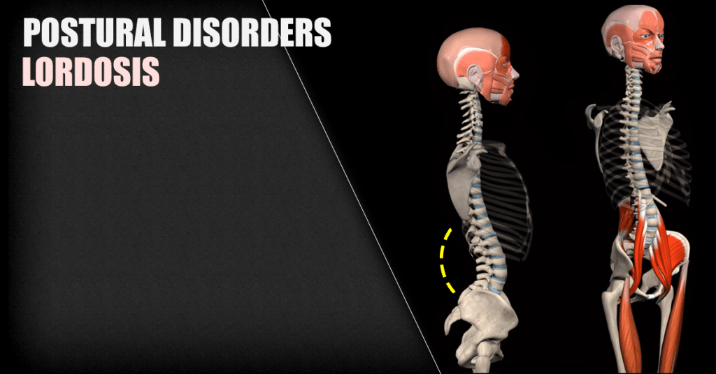 LORDOSIS