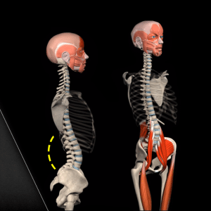 Lordosis