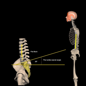 Flat Back Syndrome