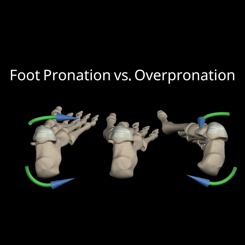 Foot Pronation vs. Overpronation