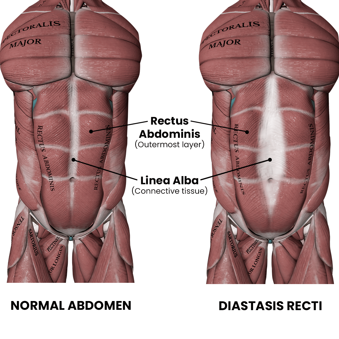 Fixing Diastasis Recti_Compare